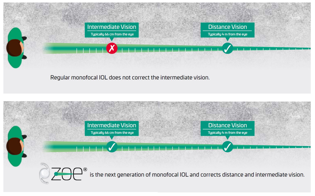 Lente Intraocular ZOE® — Más allá de lo monofocal - Image 2